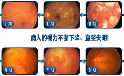 視網(wǎng)膜實(shí)力篩查儀