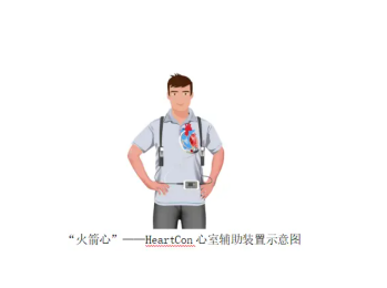 了解心臟體外輔助裝置（ECMO）的原理、應(yīng)用、優(yōu)勢