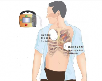 心電圖機(jī)的正確使用步驟是什么？朗逸器械百科