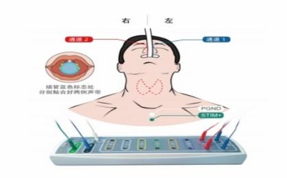 喉返神經(jīng)監(jiān)測儀生產(chǎn)廠家直供，國產(chǎn)VS進(jìn)口喉返監(jiān)測儀！